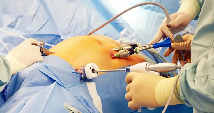 Fibroid Treatment in Ghaziabad