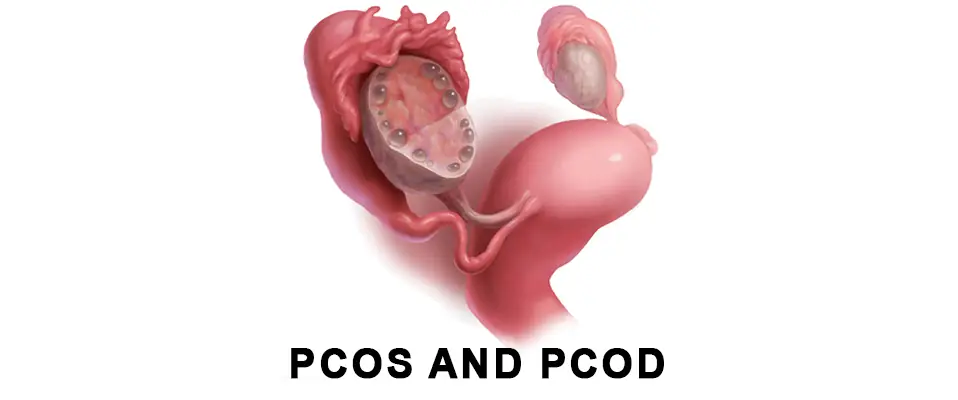 PCOS Treatment